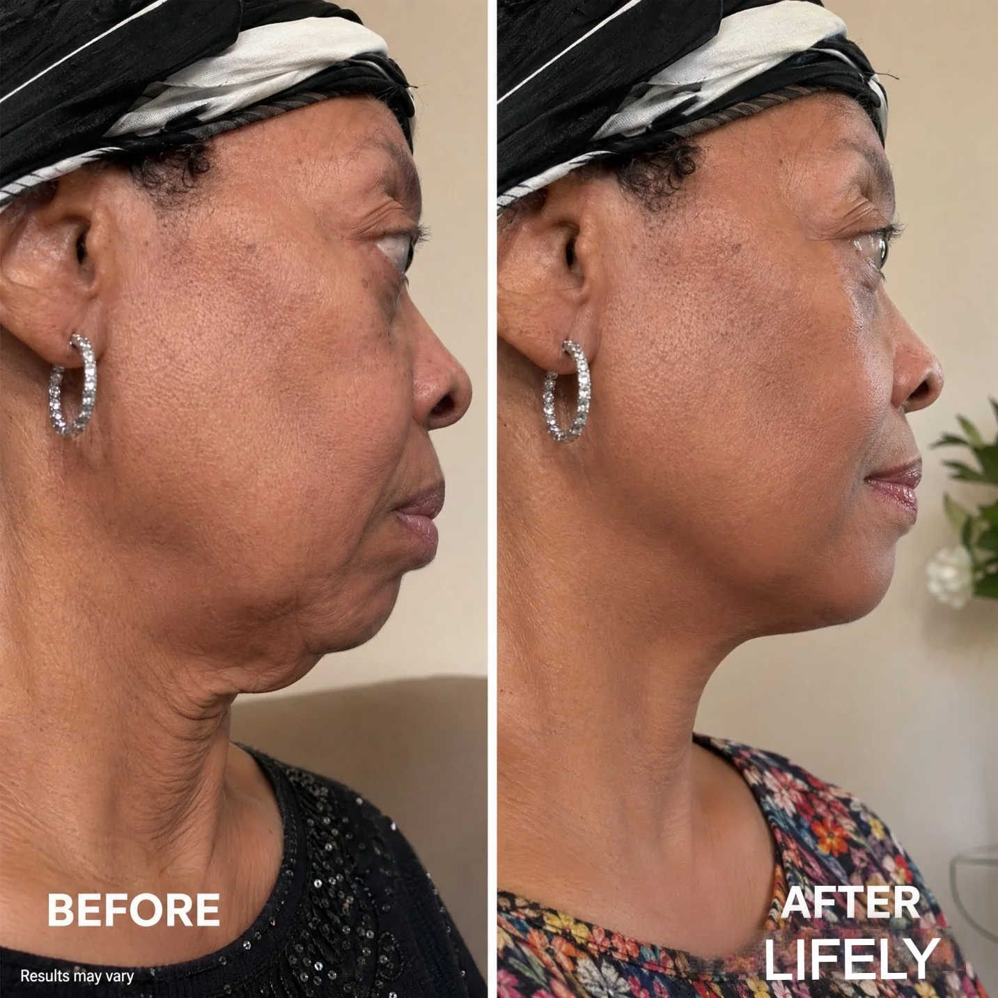 LIFELY Lifting Mask V Shape